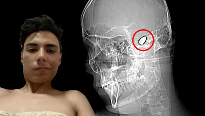 Kafasında Patlayıcıyla Yaşayan Genç: Dramatik Hikaye